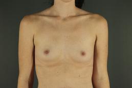 breast-augmentation-austin-tx