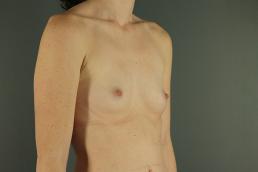 breast-augmentation-austin-tx