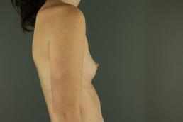 breast-augmentation-austin-tx