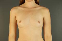 breast-augmentation-austin-tx