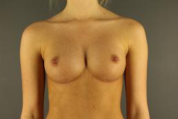 breast-augmentation-austin-tx