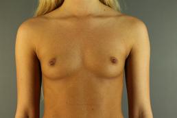 breast-augmentation-austin-tx