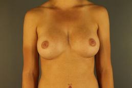 breast-augmentation-austin-tx