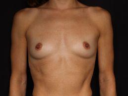 breast-augmentation-austin-tx