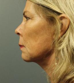 fillers-and-toxins-austin-tx