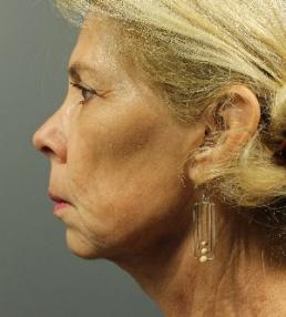 fillers-and-toxins-austin-tx