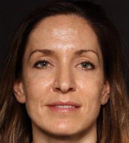 fillers-and-toxins-austin-tx