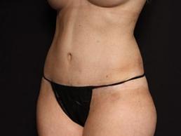 tummy-tuck-360-austin-tx