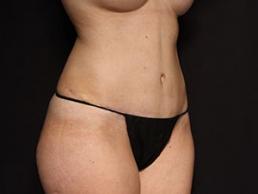 tummy-tuck-360-austin-tx