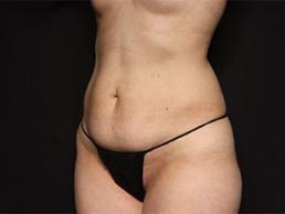 tummy-tuck-360-austin-tx