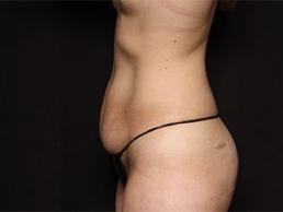 tummy-tuck-360-austin-tx