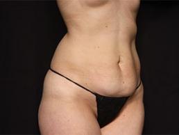 tummy-tuck-360-austin-tx