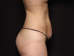 tummy-tuck-360-austin-tx