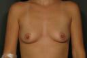 breast-augmentation-austin-tx