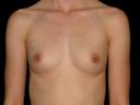 breast-augmentation-austin-tx