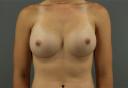 breast-augmentation-austin-tx