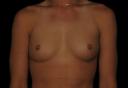 breast-augmentation-austin-tx