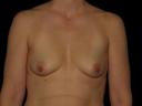 breast-augmentation-austin-tx