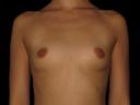 breast-augmentation-austin-tx