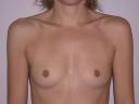 breast-augmentation-austin-tx