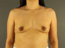 breast-augmentation-austin-tx