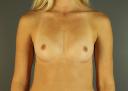 breast-augmentation-austin-tx