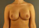 breast-augmentation-austin-tx