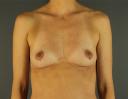 breast-augmentation-austin-tx