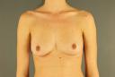 breast-augmentation-austin-tx