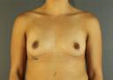 breast-augmentation-austin-tx