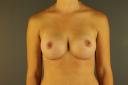 breast-augmentation-austin-tx