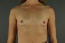 breast-augmentation-austin-tx