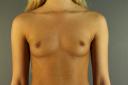 breast-augmentation-austin-tx