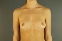 breast-augmentation-austin-tx