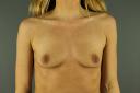 breast-augmentation-austin-tx