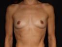 breast-augmentation-austin-tx